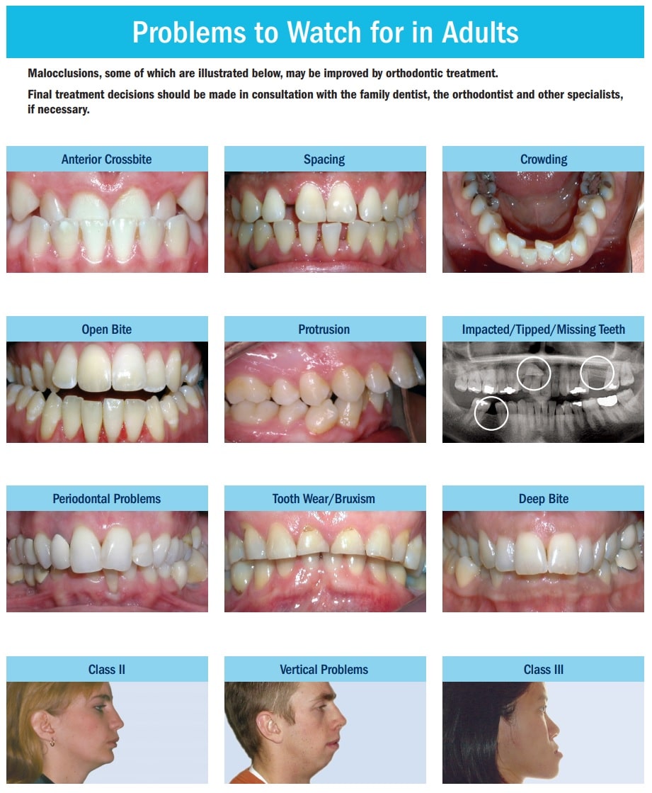 Traditional Braces, Orthodontic Treatment