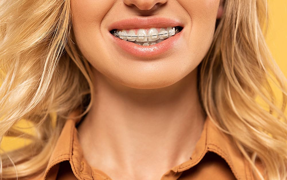 BEST Braces Near You - Miami Lingual Braces Near Me - Average Cost of  Invisalign® in Miami - Cost of Braces Near Me - Starting at $2500