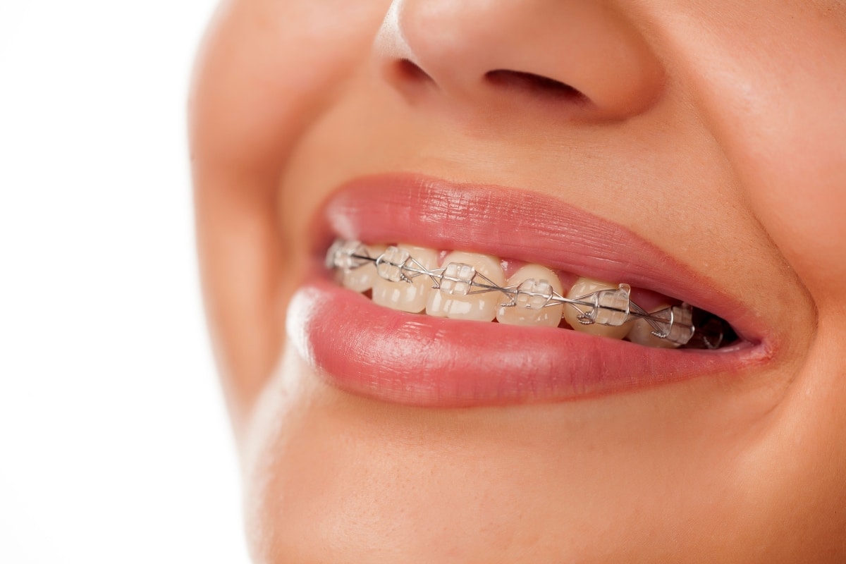 Clear Aligners Weston FL, How Clear Aligners Work