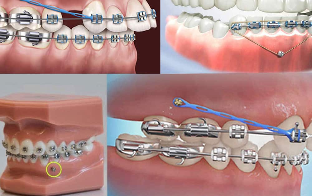 Miami Braces Near Me - Temporary Anchorage Devices TADs