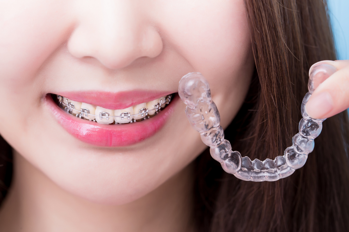 Differences Between Braces and Invisalign
