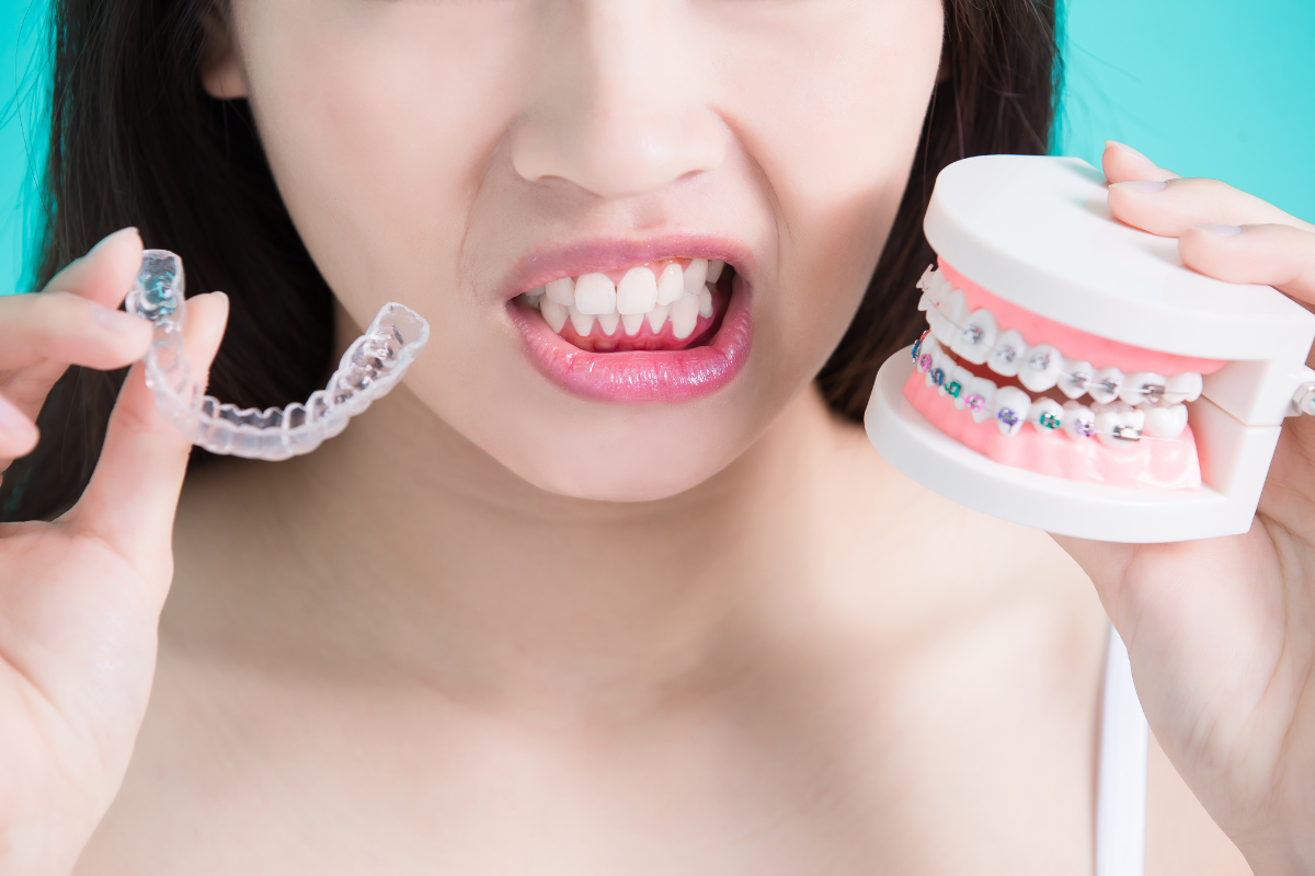 Side Effects From Braces AND Invisalign - teeth whitening after braces