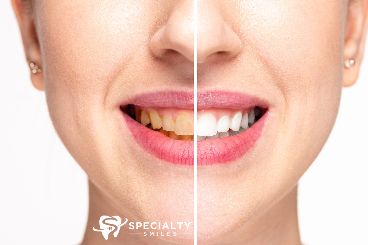 zoom professional teeth whitening before & after miami lakes fl