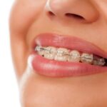 Braces In Hallandale Beach, FL