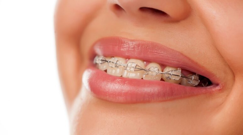 Braces In Hallandale Beach, FL