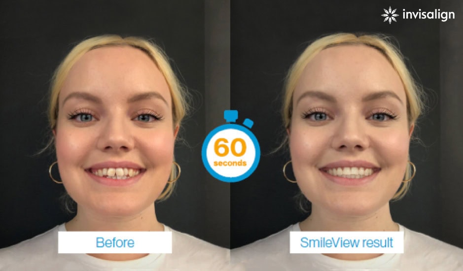 Invisalign Smile Simulator preview